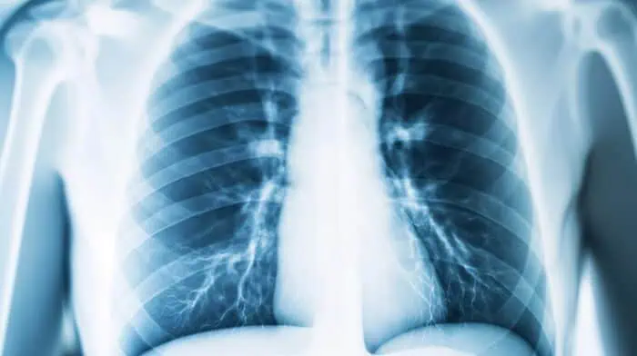 An X-ray showing pulmonary edema with fluid accumulation in the lungs.